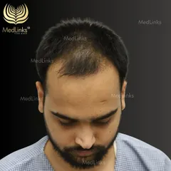 A receding hairline and thinning at the front can be a major concern. This before photo shows the extent of hair loss before we began our treatment.