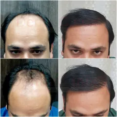 A four-panel before and after comparison showing the progression of hair growth and the final restored hairline. This highlights the significant improvement in coverage and the natural aesthetic we strive for.