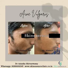 Here you can see a clear improvement in active acne and post-inflammatory marks after just 8-12 weeks of a consistent, medically supervised treatment plan. My approach focuses on controlling breakouts and preventing future scarring.