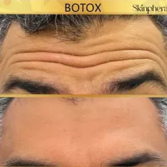This before and after image shows the effectiveness of Botox in smoothing deep-set forehead lines. The treatment relaxes the underlying muscles, resulting in a significantly smoother and more youthful appearance.