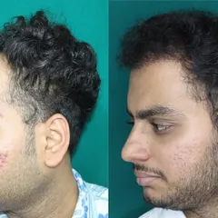 This profile view demonstrates how the new hairline seamlessly connects to the temporal points. This is a key detail for ensuring the hair transplant looks natural from all sides, not just from the front.