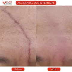 Scars can come from anywhere, not just acne. Here you can see the remarkable reduction of a prominent accidental scar on the forehead. Our treatments work to break down old scar tissue and encourage the growth of new, smoother skin, making past injuries much less visible.