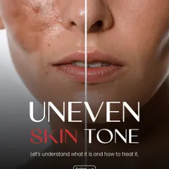 A powerful before-and-after visual demonstrating the effectiveness of our treatments for uneven skin tone. We help patients achieve a balanced and radiant complexion.