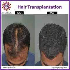 A top-down view showcasing the remarkable results of our hair transplant procedure. We successfully filled in the thinning crown area, achieving a full and youthful appearance.