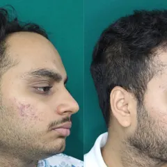 Another angle highlighting the restored hairline and its natural flow. My goal is always to create hair that you can style and live with, without anyone knowing you've had a procedure.