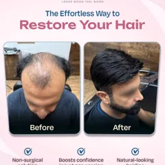 This transformation highlights the confidence boost that comes with a restored hairline. Our non-surgical solution provided this client with a natural-looking result in just one session, effortlessly covering the balding area.