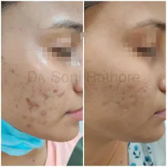 Here is another example of getting active acne under control. By calming the inflammation and preventing new pimples, we create a clear canvas to work on for any residual scarring or pigmentation.