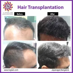 This client regained a fuller, more youthful hairline with our hair transplantation service. The 'after' photos show increased density and a well-defined hairline from both top and side angles.