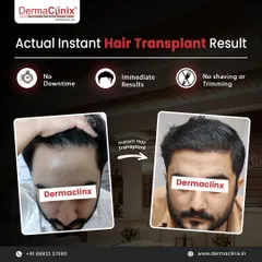 This before and after comparison highlights the key benefits of an Instant Hair Transplant. The procedure provides immediate results with no downtime and, crucially, no shaving or trimming required.