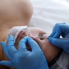 Gentle and precise extraction is an important step for clearing congested pores. I perform this carefully after steaming the skin to ensure minimal discomfort and clear results.