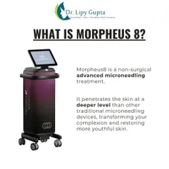 This explains what Morpheus8 technology is. The device penetrates the skin at a deeper level to transform your complexion and restore more youthful-looking skin by stimulating collagen production.