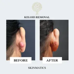 This before and after shows the result of a keloid removal from an ear piercing. This is a common issue, and we use precise surgical excision techniques to safely remove the overgrown scar tissue and carefully restore the natural shape of the ear with the best possible cosmetic outcome.