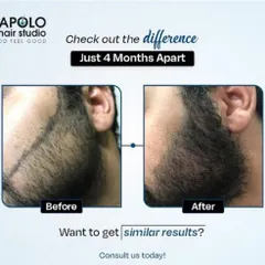 This comparison shows the progress over four months for a client who wanted to conceal a facial scar and achieve a fuller beard. The after image demonstrates how the transplanted hair grows in naturally, blending perfectly with the existing hair.
