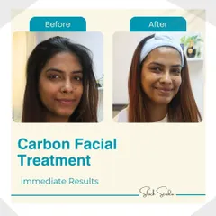 The immediate results of a Carbon Facial are clear in this before-and-after. Her skin is visibly brighter, smoother, and more radiant right after the treatment.
