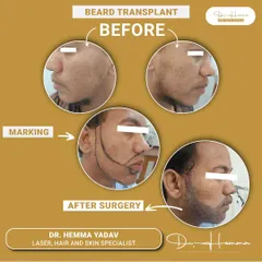 This collage breaks down the beard transplant process. You can see the 'before' state with sparse growth, the 'marking' phase where I outline the new beard shape, and the 'after surgery' result showing a full, well-defined beard. It’s a transformative procedure.