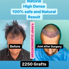 Here is a client before and just after surgery, where 2250 grafts were implanted to create a new, dense hairline. This demonstrates what you can expect on the day of your high-density FUE transplant.
