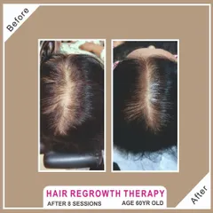 It's never too late to invest in your hair. This wonderful 60-year-old client saw a remarkable improvement in her hair volume and scalp coverage after completing 8 sessions of our hair regrowth therapy.