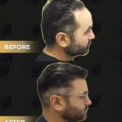 A side-profile before and after of cricketer Parthiv Patel. We implanted 2400 grafts to address his Grade 2 baldness, focusing on the hairline and frontal density for a fuller, youthful look.