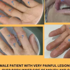 This patient came to me with very painful lesions on her hands and inside her mouth, a condition she had been struggling with for five years. This image shows the state of her hands before we began the Ayurvedic treatment protocol.