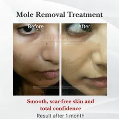 Another example of our successful mole removal treatment, showing a clear result just one month after the procedure. We focus on achieving smooth, scar-free skin to restore total confidence.