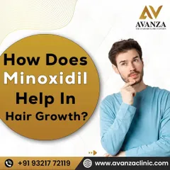 For many clients, non-surgical options are the best starting point. This graphic explains how a medically-proven solution like Minoxidil works to stimulate hair growth. We believe in educating you about all effective treatment paths available.