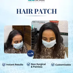 Our customizable hair patches offer instant, non-surgical, and painless results for women. This client regained a full hairline, restoring her confidence.