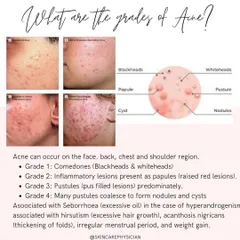 Acne isn't one-size-fits-all. I diagnose it in grades, from Grade 1 (blackheads and whiteheads) to Grade 4 (severe cysts and nodules), which helps determine the most effective treatment path.