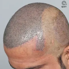 This patient came to us for a corrective hair transplant. We used 5500 grafts to recreate his hairline and re-densify the frontal part, mid-scalp, and crown.