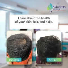 A picture is worth a thousand words. This before and after demonstrates a significant increase in hair volume and scalp coverage after a personalized hair restoration plan. My goal is always to deliver results that look and feel natural.
