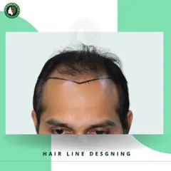 A crucial step in any hair transplant is the hairline design. This image shows a meticulously drawn V-shaped hairline, customized to create a natural and youthful appearance for the client.