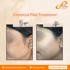 A clear before and after of a chemical peel treatment. This demonstrates how the procedure can significantly improve skin texture and tone, leaving the skin looking radiant.