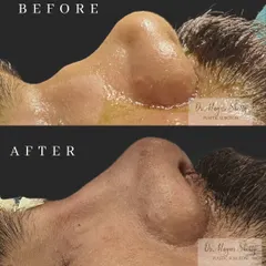 This patient presented with a severe saddle nose deformity, where the bridge of the nose is sunken. Using a rib graft and Piezotome technology, I reconstructed the bridge and refined the tip, restoring a strong and straight profile right on the operating table.
