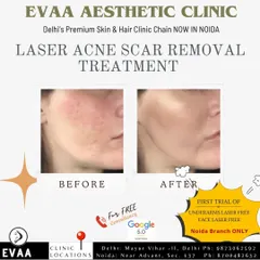 See the visible reduction in acne scarring with our Laser Acne Scar Removal Treatment. This before-and-after shows significant improvement in skin texture and smoothness.