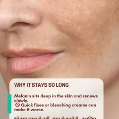 Pigmentation stays so long because the melanin sits deep within the skin. Quick fixes or harsh bleaching creams can often make the problem worse, which is why a patient, professional approach is necessary.