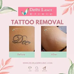 Here is a clear before and after from a laser tattoo removal treatment. We used our US FDA-approved Medlite C6 Q-Switch laser to break down the ink particles over several sessions, resulting in the tattoo fading completely and leaving clear skin.
