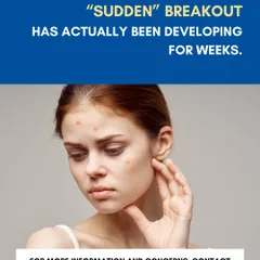 What feels like a sudden breakout has actually been developing for weeks. This is why consistent skincare and early intervention are so important for managing acne-prone skin and preventing future pimples.