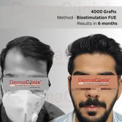 This is a clear example of what's possible with our Biostimulation FUE method. This patient received 4000 grafts, and this is the significant regrowth and density achieved in just six months.