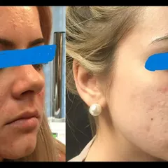 This before-and-after shows the transformative power of Microneedling Radiofrequency (MNRF) on acne scars and skin texture. By delivering energy deep into the dermis, I can remodel collagen for smoother, clearer skin.