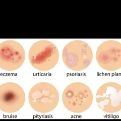 This graphic shows several common skin conditions I treat in children, including eczema, psoriasis, acne, and vitiligo. Early and accurate diagnosis by a dermatologist is key to effective management and preventing long-term issues.