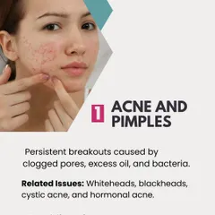 Acne and pimples are persistent breakouts caused by clogged pores, excess oil, and bacteria. Related issues include whiteheads, blackheads, and cystic acne.