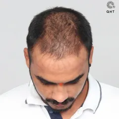 A complete 10-month transformation for a Diffuse Grade 5A case. We recreated the hairline and added density to the frontal and mid-scalp with 3,800 grafts.