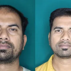 A strong hairline frames the face and restores a youthful appearance. For this patient, I focused on rebuilding his receding hairline and adding density to the frontal region. The result is a natural-looking frame for his face that boosts his confidence.