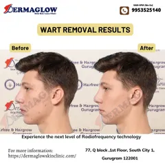Notice the complete clearance of facial warts in this before-and-after comparison. Our procedure is designed to be effective and gentle, leaving behind smoother skin with minimal signs of the previous blemishes.