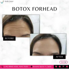 This before and after image shows the effective reduction of deep forehead wrinkles using Botox. The result is a smoother, more youthful forehead while maintaining natural expression.