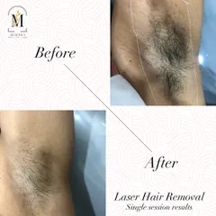 A clear look at the effectiveness of a single underarm laser session. This is a very popular treatment area, and clients are often amazed by the quick reduction in hair.