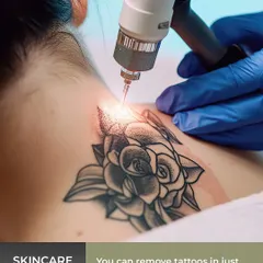 An action shot of a laser tattoo removal session on the neck. The laser is precisely targeted to break down the ink particles without harming the surrounding skin.