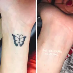 This is another example of a butterfly tattoo, this one a solid black silhouette on the wrist, which has been completely cleared after laser removal sessions.