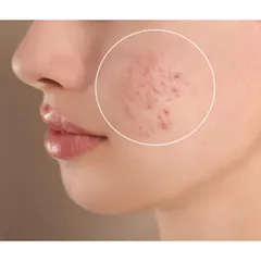 For persistent acne, I focus on healing from the inside out. This condition is often due to excess Pitta and toxins, or 'ama'. My anti-acne treatments involve blood-purifying herbs like Neem and Lodhra, combined with external applications (Lepanam) to reduce inflammation and prevent scarring for clear, healthy skin.