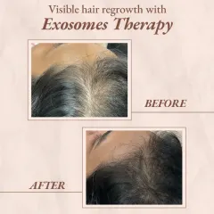 Another successful result from Exosomes Therapy, this time focusing on the frontal hairline. Notice the increase in finer, new hairs and overall thickness, which helps frame the face more softly.