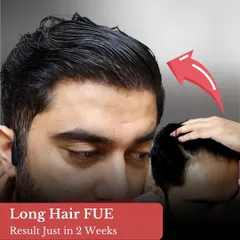 This image shows the result of a Long Hair FUE just two weeks after the procedure. The patient can walk out with confidence, as there is no trimming, no shaving, and no downtime required.